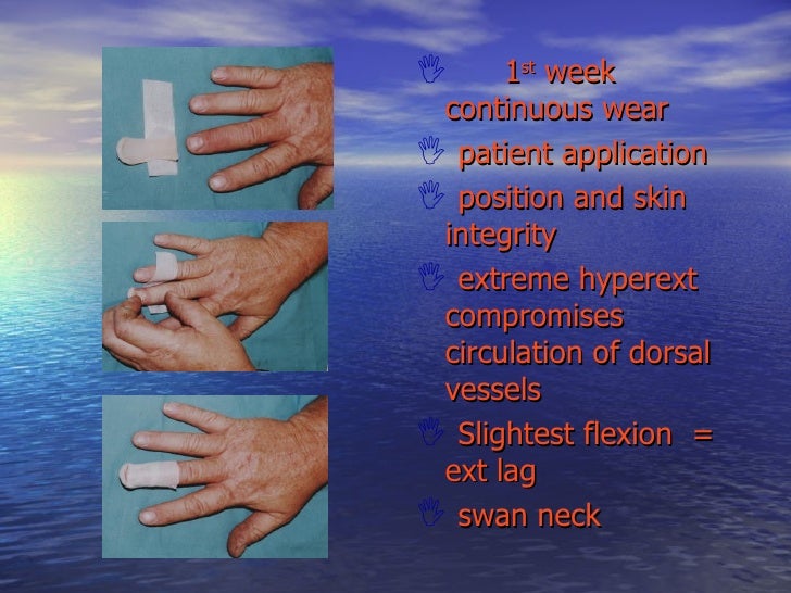 Hand Therapy Rehabilitation Extensor Tendons