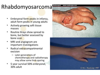 Rhabdomyosarcoma
 •   Embryonal form peaks in infancy,
     adult form peaks in young adults
 •   Actively growing soft tissue
     masses
 •   Routine Xrays show spread to
     bone, but better assessed by
     bone scan
 •   MRI and angiogram are
     important investigations
 •   Radical extracompartmental
     excision
      – Later generations of
        chemotherapy and radiotherapy
        may allow some limb sparing
 •   5 year survival 50% embryonal,
     30% adult
 