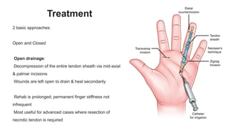 Incision Finger Pulp A BRIEF PRESENTION ON HAND AND HAND INFECTIONS | PPTX
