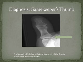 Avulsion of UCL (ulnar collateral ligament) of the thumb
Also known as Skier’s thumb

 