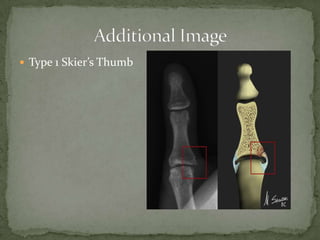  Type 1 Skier’s Thumb

 