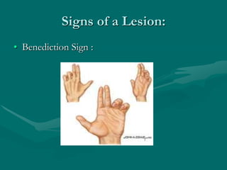Signs of a Lesion:
• Benediction Sign :
 