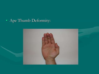 • Ape Thumb Deformity:
 