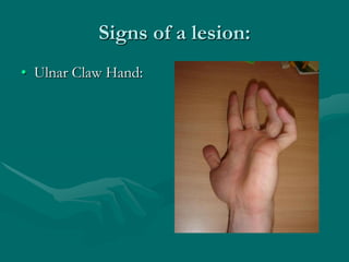 Signs of a lesion:
• Ulnar Claw Hand:
 