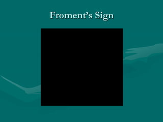 Froment’s Sign
 