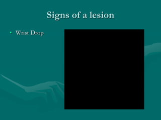 Signs of a lesion
• Wrist Drop
 