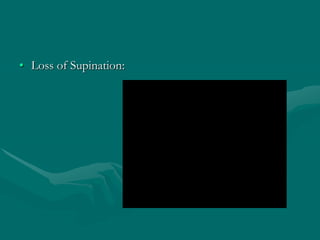 • Loss of Supination:
 