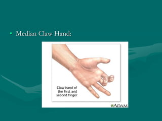 Signs of a lesion:
• Ulnar Claw Hand:
 