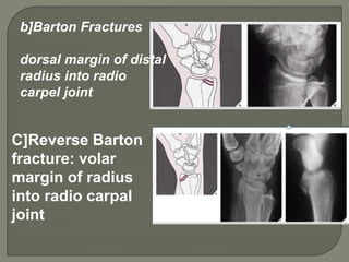 Barton Type Hand and fore arm radiology truma girish gunar | PPTX