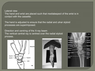Tangential Hand View Radiography Hand and fore arm radiology truma girish gunar | PPTX