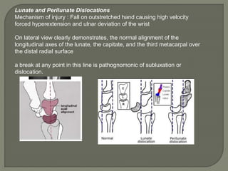 Hand and fore arm radiology truma girish gunar | PPTX