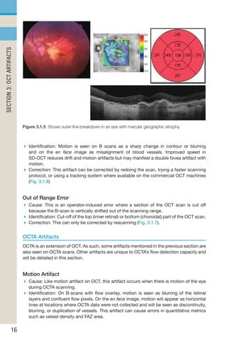 Oct Artefact Example Handbook of Retinal OCT Second Edition.. | PDF