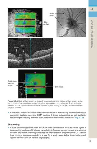 Handbook of Retinal OCT Second Edition.. | PDF