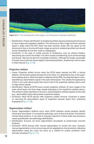 Oct Artefact Example Handbook of Retinal OCT Second Edition.. | PDF