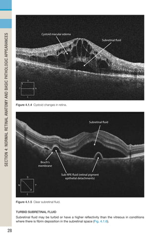 Fluid Under Rpe Handbook of Retinal OCT Second Edition.. | PDF