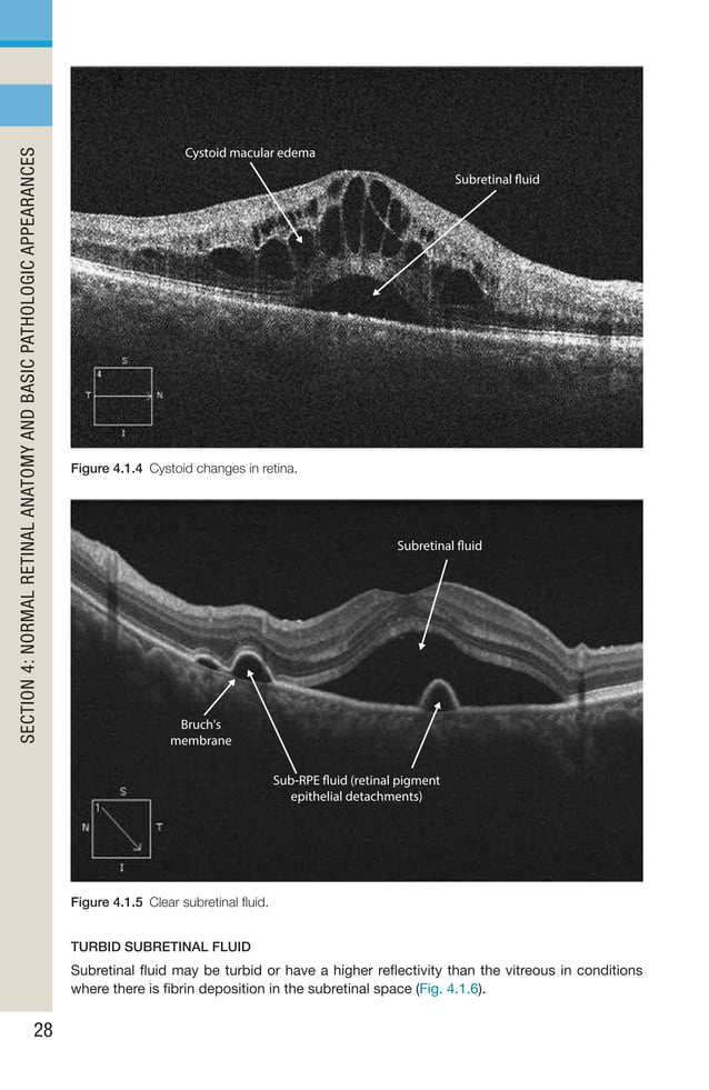 Retinal Rao Oct Handbook of Retinal OCT Second Edition.. | PDF