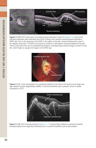 Fluid Below Rpe Handbook of Retinal OCT Second Edition.. | PDF