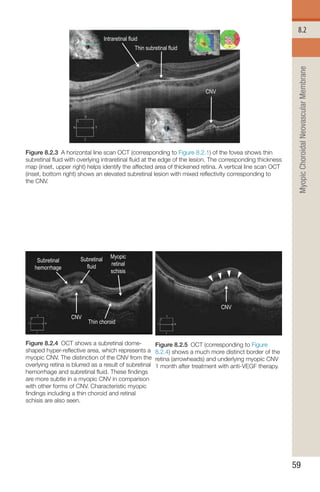 Neovascular Net On 5 Line Rastor Oct Handbook of Retinal OCT Second Edition.. | PDF