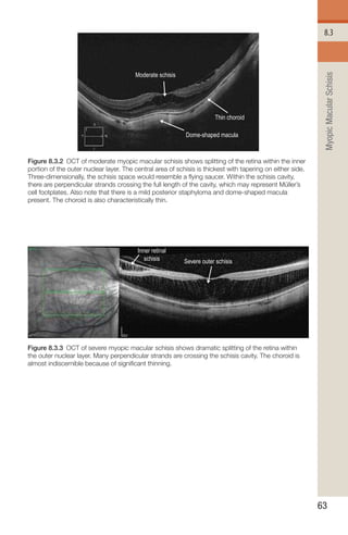 Handbook of Retinal OCT Second Edition.. | PDF