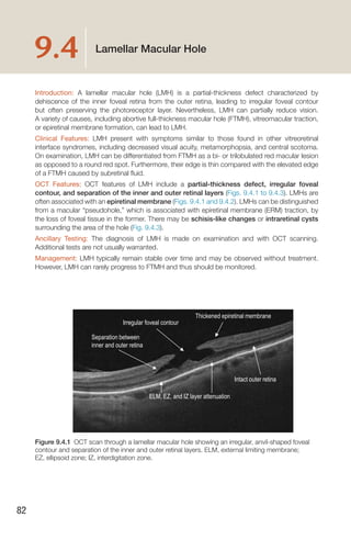 Handbook of Retinal OCT Second Edition.. | PDF