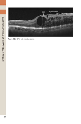 Handbook of Retinal OCT Second Edition.. | PDF