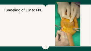 14
Tunneling of EIP to FPL
 