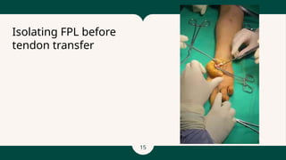 15
Isolating FPL before
tendon transfer
 