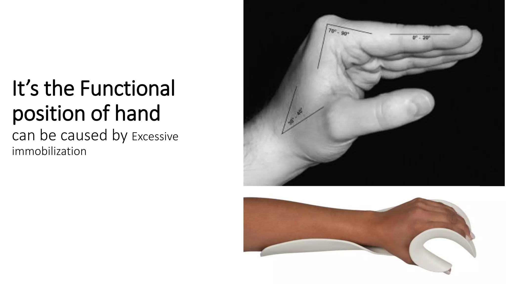 It’s the Functional
position of hand
can be caused by Excessive
immobilization
 