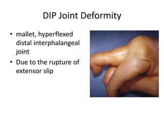 DIP Joint Deformity 
• mallet, hyperflexed 
distal interphalangeal 
joint 
• Due to the rupture of 
extensor slip 
 