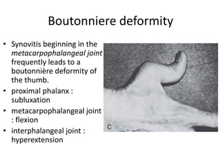 Boutonniere deformity 
• Synovitis beginning in the 
metacarpophalangeal joint 
frequently leads to a 
boutonnière deformity of 
the thumb. 
• proximal phalanx : 
subluxation 
• metacarpophalangeal joint 
: flexion 
• interphalangeal joint : 
hyperextension 
 