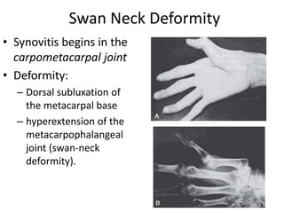 Swan Neck Deformity 
• Synovitis begins in the 
carpometacarpal joint 
• Deformity: 
– Dorsal subluxation of 
the metacarpal base 
– hyperextension of the 
metacarpophalangeal 
joint (swan-neck 
deformity). 
 