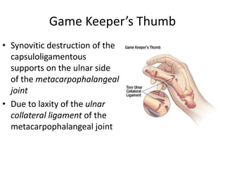 Game Keeper’s Thumb 
• Synovitic destruction of the 
capsuloligamentous 
supports on the ulnar side 
of the metacarpophalangeal 
joint 
• Due to laxity of the ulnar 
collateral ligament of the 
metacarpophalangeal joint 
 
