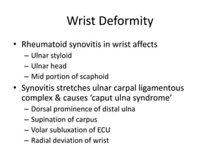 Wrist Deformity 
• Rheumatoid synovitis in wrist affects 
– Ulnar styloid 
– Ulnar head 
– Mid portion of scaphoid 
• Synovitis stretches ulnar carpal ligamentous 
complex & causes ‘caput ulna syndrome’ 
– Dorsal prominence of distal ulna 
– Supination of carpus 
– Volar subluxation of ECU 
– Radial deviation of wrist 
 