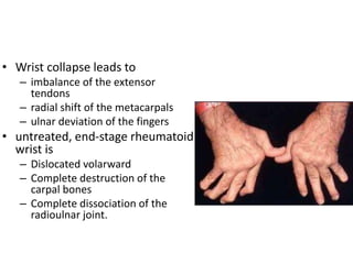 • Wrist collapse leads to 
– imbalance of the extensor 
tendons 
– radial shift of the metacarpals 
– ulnar deviation of the fingers 
• untreated, end-stage rheumatoid 
wrist is 
– Dislocated volarward 
– Complete destruction of the 
carpal bones 
– Complete dissociation of the 
radioulnar joint. 
 
