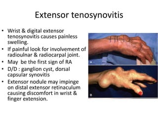 Extensor tenosynovitis 
• Wrist & digital extensor 
tenosynovitis causes painless 
swelling. 
• If painful look for involvement of 
radioulnar & radiocarpal joint. 
• May be the first sign of RA 
• D/D : ganglion cyst, dorsal 
capsular synovitis 
• Extensor nodule may impinge 
on distal extensor retinaculum 
causing discomfort in wrist & 
finger extension. 
 