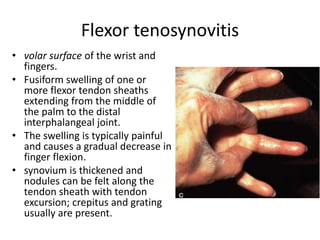 Flexor tenosynovitis 
• volar surface of the wrist and 
fingers. 
• Fusiform swelling of one or 
more flexor tendon sheaths 
extending from the middle of 
the palm to the distal 
interphalangeal joint. 
• The swelling is typically painful 
and causes a gradual decrease in 
finger flexion. 
• synovium is thickened and 
nodules can be felt along the 
tendon sheath with tendon 
excursion; crepitus and grating 
usually are present. 
 