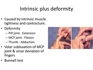 Intrinsic plus deformity 
• Caused by intrinsic muscle 
tightness and contracture. 
• Deformity 
– PIP joint : Extension 
– MCP joint : Flexion 
– Thumb : Adduction 
• Volar subluxation of MCP 
joint & ulnar deviation of 
fingers 
• Bunnell test 
 