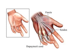 Hand Somatic Dysfunction Hand Disorders.ppt