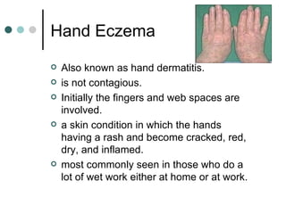 Hand Eczema ,[object Object],[object Object],[object Object],[object Object],[object Object]