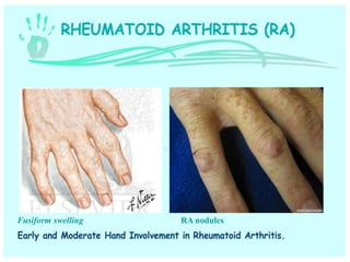 swellingFusiform RA nodules
 