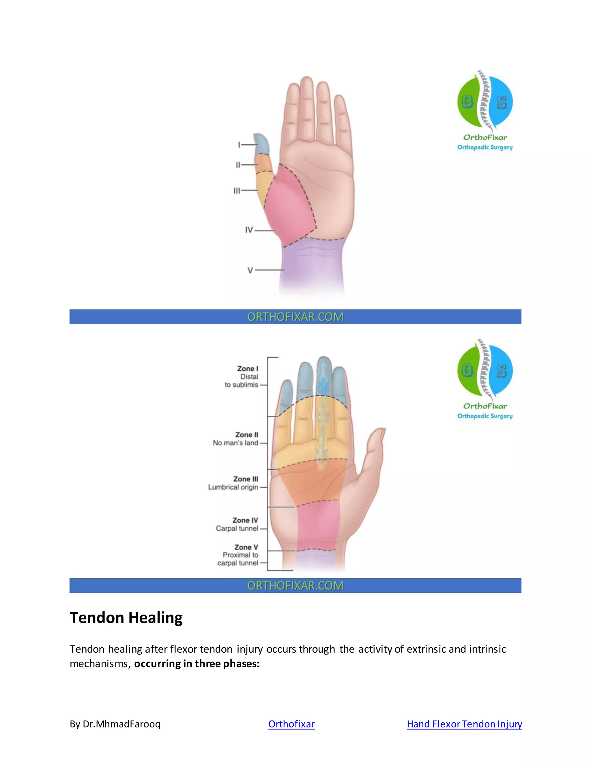 By Dr.MhmadFarooq Orthofixar Hand FlexorTendonInjury
Tendon Healing
Tendon healing after flexor tendon injury occurs through the activity of extrinsic and intrinsic
mechanisms, occurring in three phases:
 