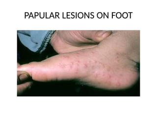 Diffuse Papular Foot Rash HAND FOOT MOUTH DISEASE PppppppppPT.pptx