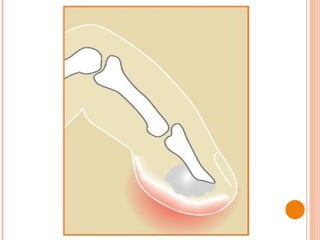 Hand infections | PPT