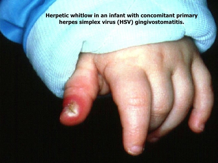 Hand Infections
