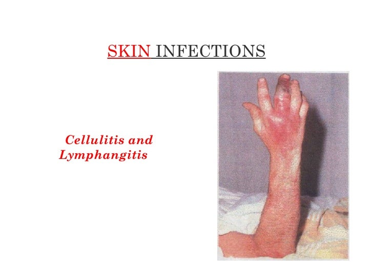 Hand infections