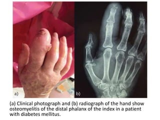 (a) Clinical photograph and (b) radiograph of the hand show
osteomyelitis of the distal phalanx of the index in a patient
with diabetes mellitus.
 