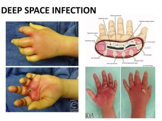 DEEP SPACE INFECTION
 