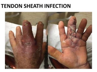 TENDON SHEATH INFECTION
 