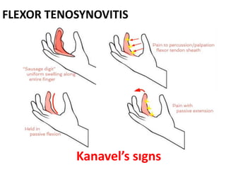 FLEXOR TENOSYNOVITIS
Kanavel’s signs
 