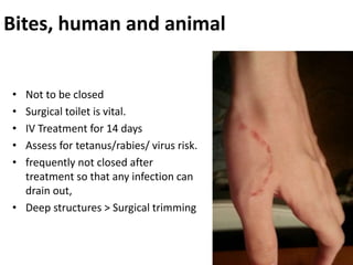 Bites, human and animal
• Not to be closed
• Surgical toilet is vital.
• IV Treatment for 14 days
• Assess for tetanus/rabies/ virus risk.
• frequently not closed after
treatment so that any infection can
drain out,
• Deep structures > Surgical trimming
 